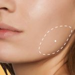 Masseter-Reduction
